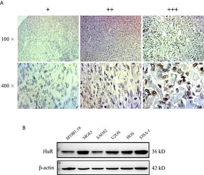 Silencing of HuR Inhibits Osteosarcoma Cell Epithelial-Mesenchymal Transition via AGO2 in Association With Long Non-Coding RNA XIST